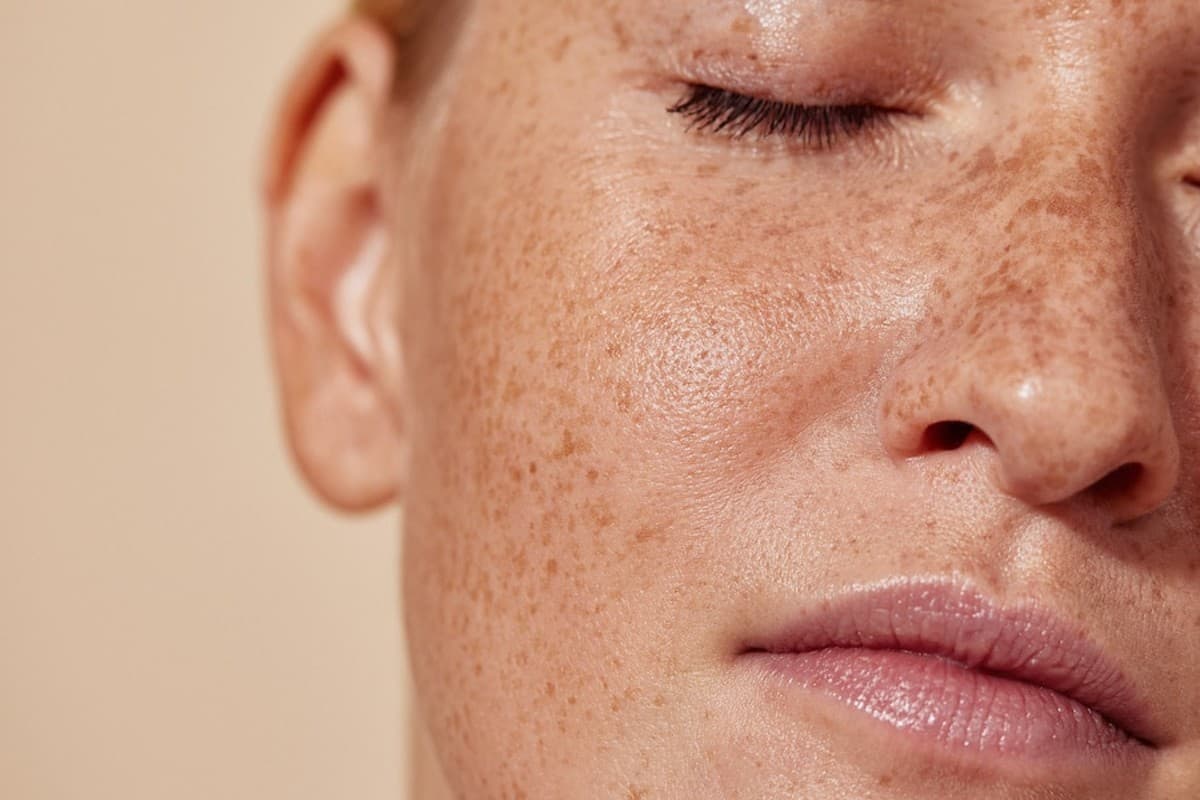 Home Remedies To Remove Dark Spots On Face: इस विटामिन की कमी से होता है चेहरे पर ब्लैक स्पॉट्स, जानें घरेलू उपाय