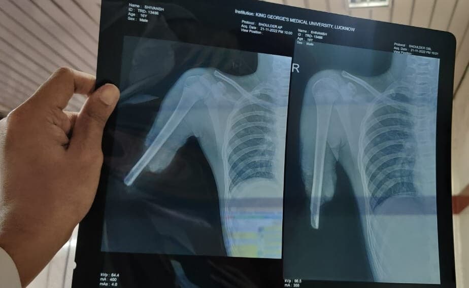 देवघर में सरकारी स्तर पर लोगों को नहीं मिल रही एक्स-रे की सुविधा