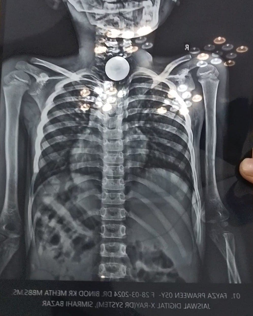 Supaul: गले में फंसा सिक्का निकालने के क्रम में बच्ची की मौत, परिजनों ने गलत इलाज का लगाया आरोप