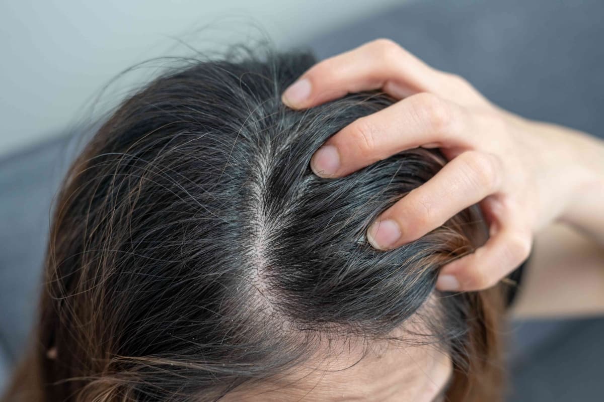 Itchy Scalp Problem: गर्मी के मौसम में बालों में खुजली से हैं परेशान, तो ये हैं आप के लिए कुछ आसान उपाय