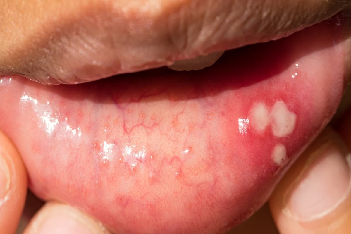 Home Remedies For Mouth Sores: अगर आप मुंह के छालों से परेशान हैं, तो आजमाएं ये घरेलू नुस्खे