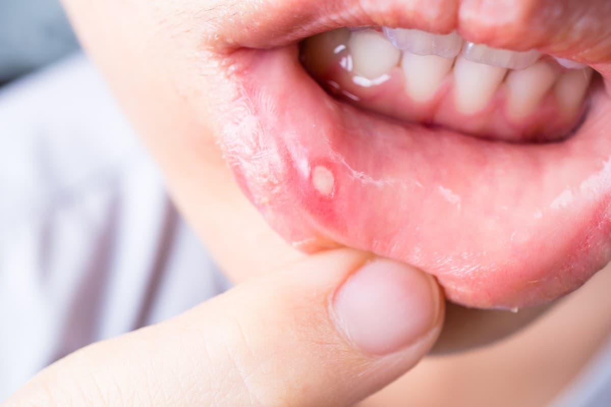 World Oral Health Day 2024: किसी भी उम्र में हो सकता है माउथ कैंसर, जानिए कारण, लक्षण और इलाज