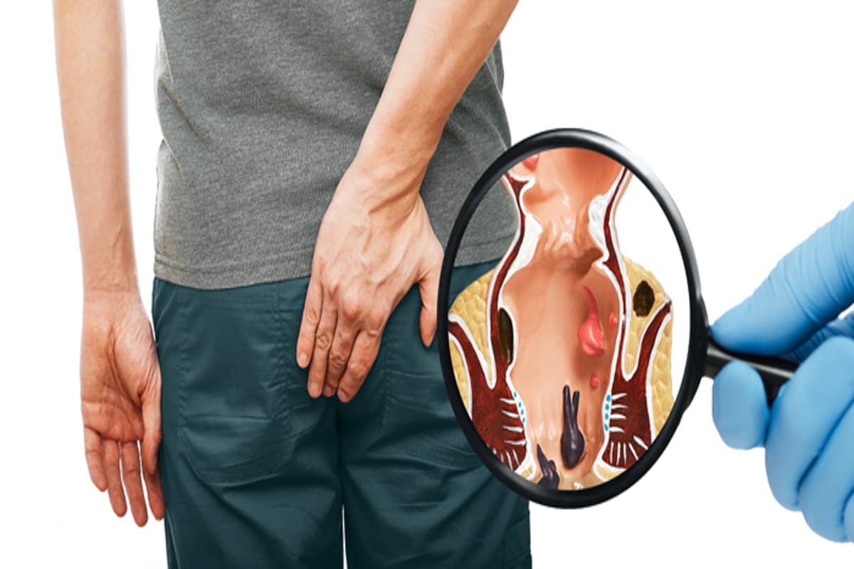 Piles In Diabetic Patients: डायबिटीज के मरीज को अगर बवासीर हो जाए तो क्या करना चाहिए?