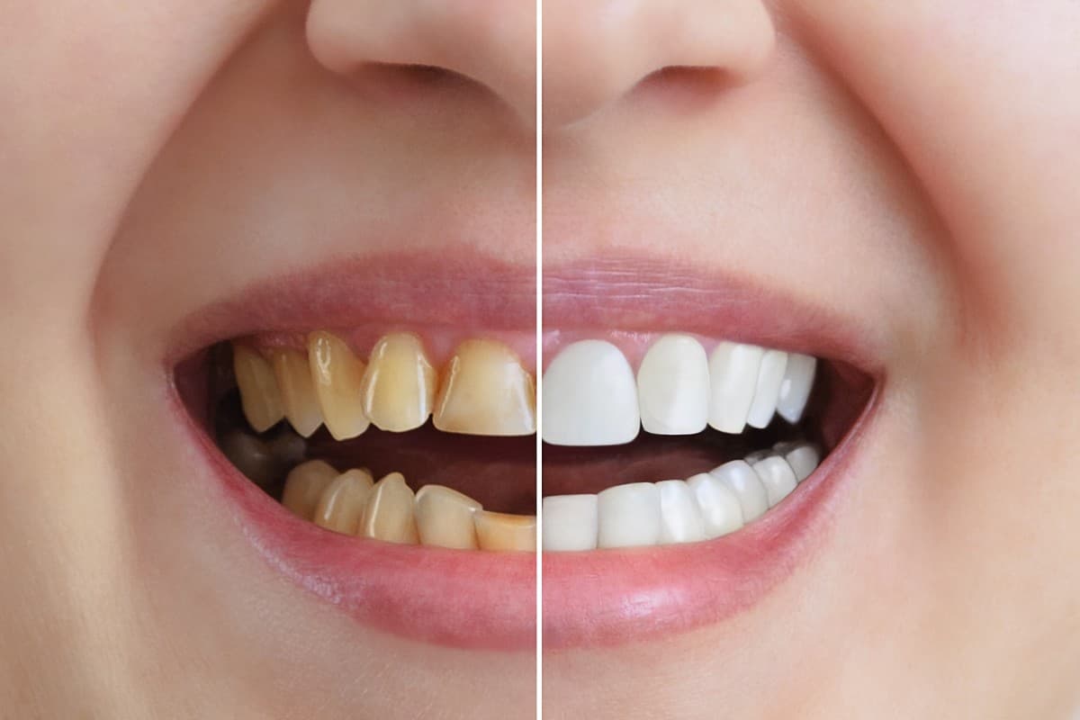 Herbs For Teeth: मोतियों की तरह चमकने लगेंगे आपके दांत, अगर आप इन जड़ी-बूटियों का करेंगे इस्तेमाल