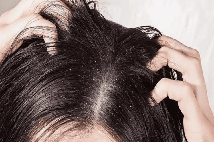Ayurvedic Herbs for Dandruff: गर्मी में बालों में पड़ी है रूसी तो इन आयुर्वेदिक हर्ब के इस्तेमाल से करें दूर