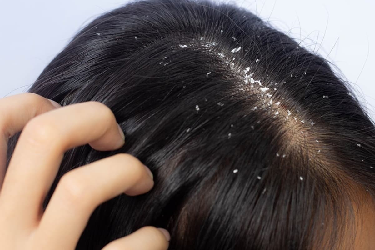 Dandruff Home Remedies