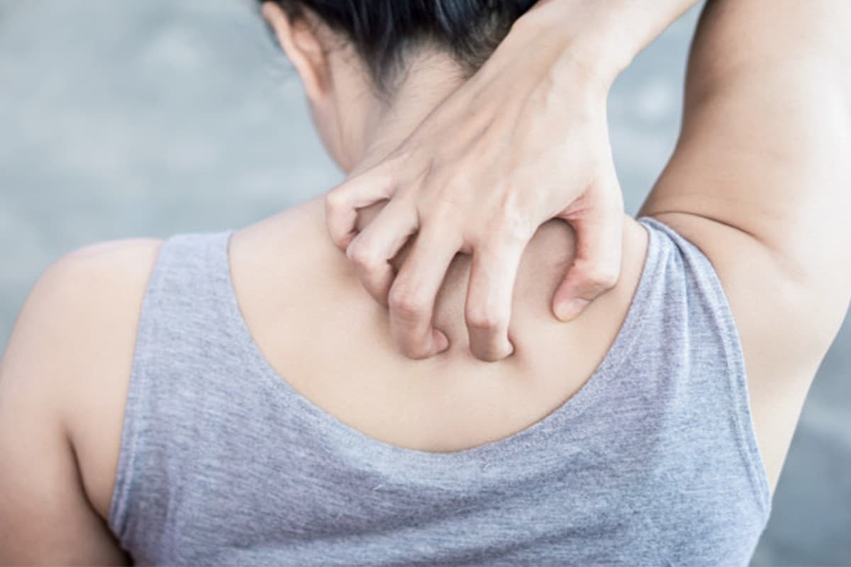 Home Remedies Heat Rash: गर्मियों में हैं घमौरियों से तंग तो तुरंत अपनाएं ये घरेलू नुस्खे