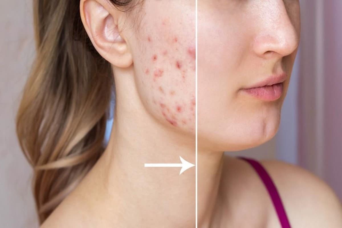 Home Remedies for Acne Scars