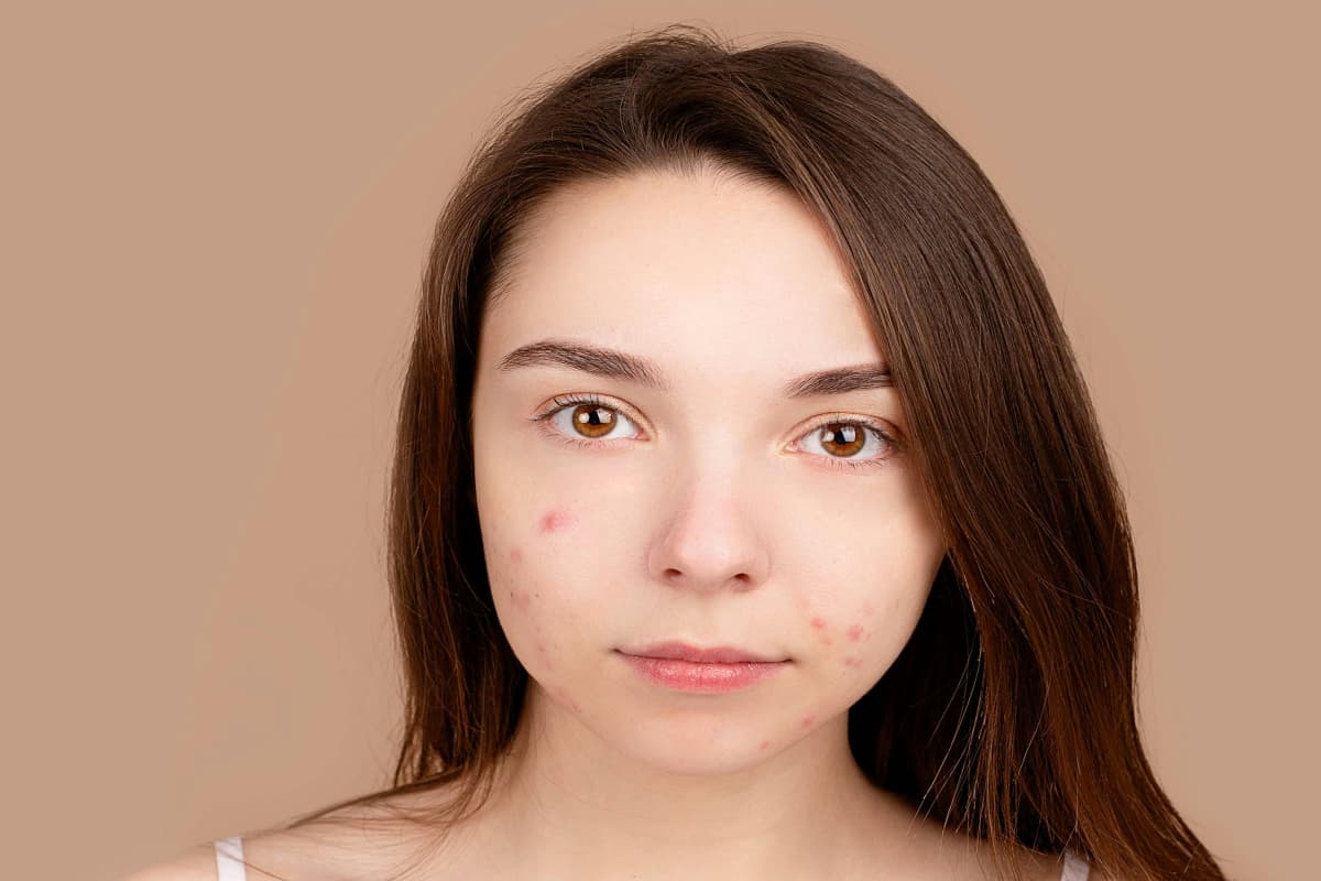 Acne: इस तरह अपने चेहरे से हटाएं मुंहासे के दाग
