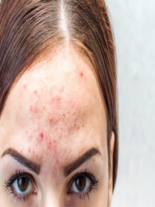 Beauty Tips: फोड़े-फुंसी से छुटकारा पाने के घरेलू नुस्खे: प्राकृतिक उपचार और सावधानियाँ