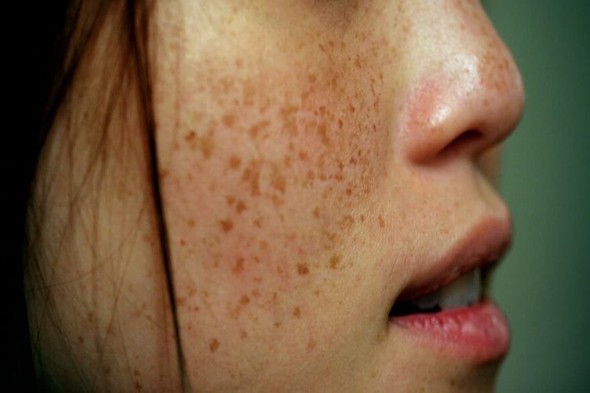 Freckles Face: रातों रात झाइयां कम करने का उपाय, ब्यूटी एक्सपर्ट से जानिए