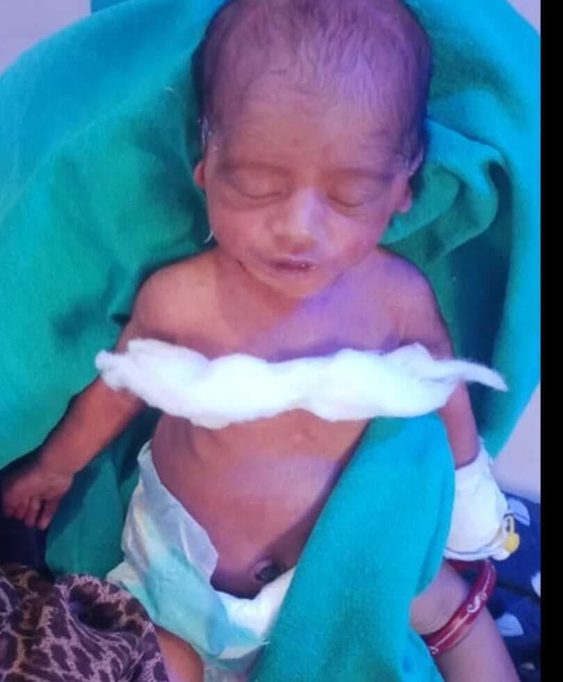 चार घंटे के जटिल ऑपरेशन के बाद बचायी नवजात की जान