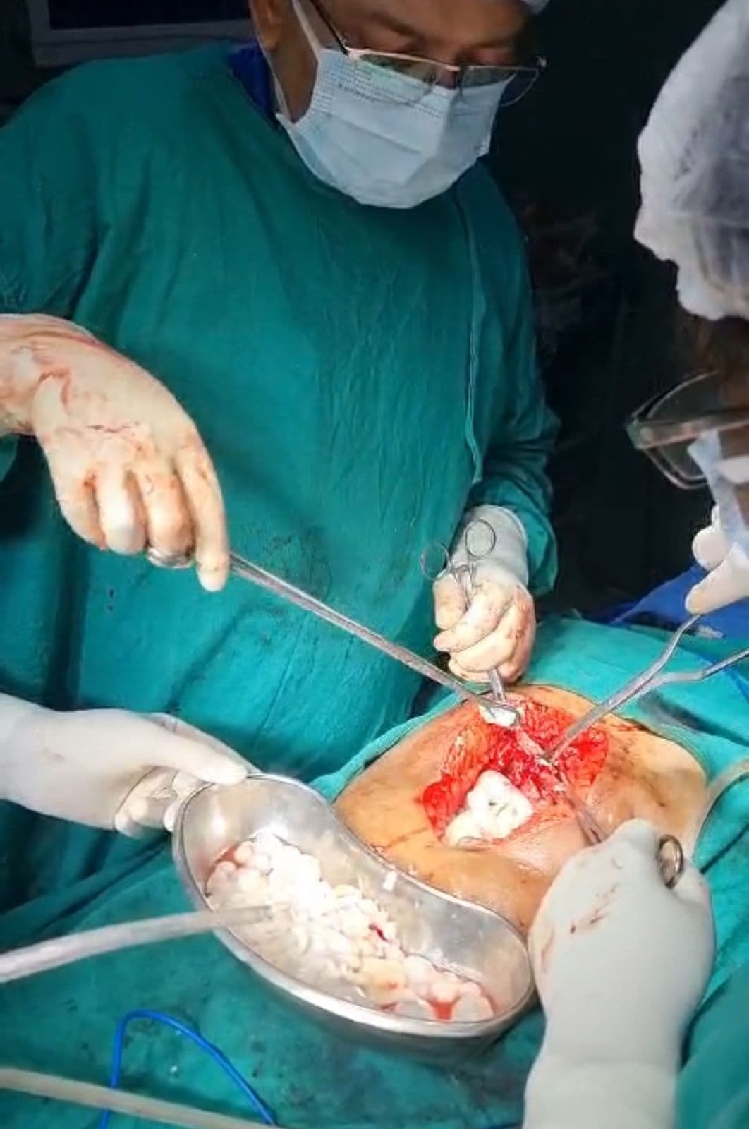 आरोग्यम में  लिवर की हाइडैटिड बीमारी का सफल ऑपरेशन