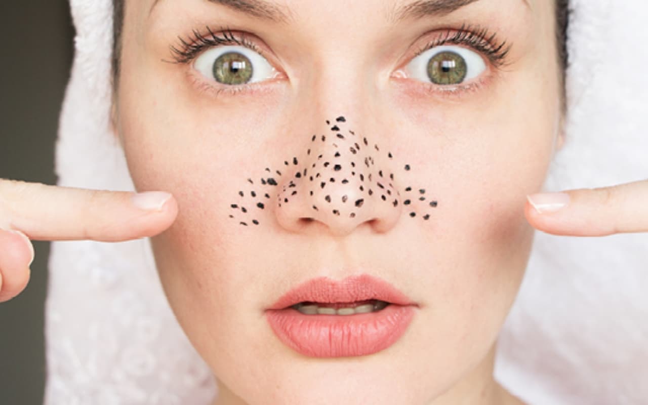 DIY blackhead removal: नेचुरल तरीके ब्लैकहेड्स को हटाने के लिए घरेलू उपचार