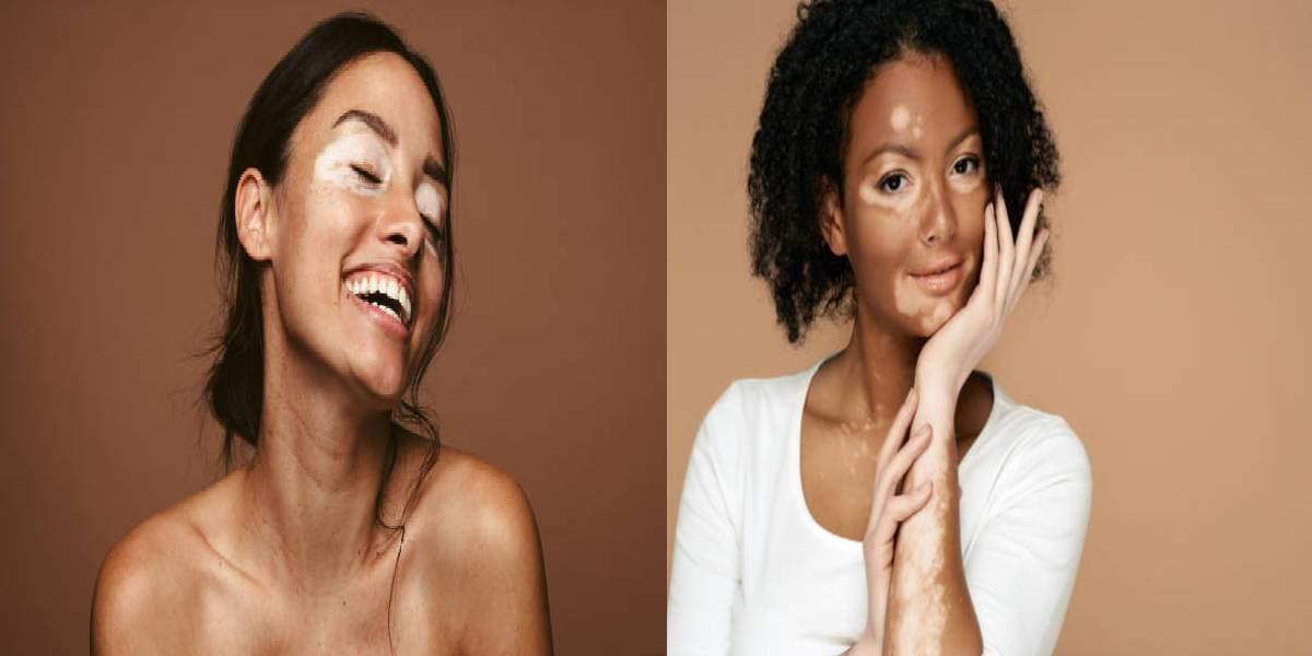 World Vitiligo Day 2024: क्यों होते हैं शरीर पर सफेद दाग, जानें इस दिन को मनाने का उद्देश्य