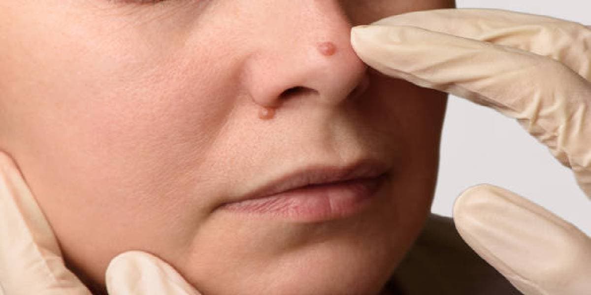 Remove to Unwanted Moles: बिना सर्जरी के हटाएं अनचाहे तिल, करें ये घरेलू उपाय