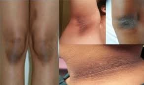 Skincare Tips : गले और गुटनों के नीचे जम गया है कालापन, ट्राई करें घरेलू नुश्खे, ये रही कुछ आसान ट्रिक्स