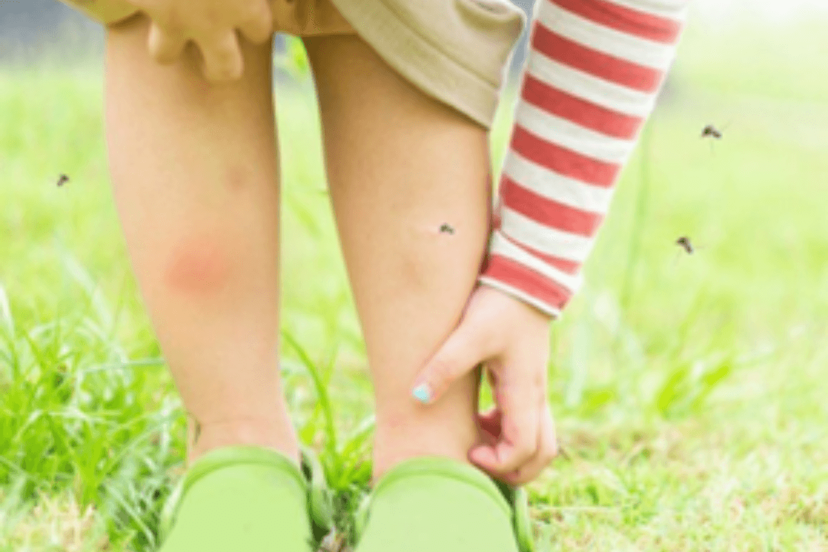 Monsoon health : मानसून में पैरों को बचाएं फंगल इंफेक्शन से