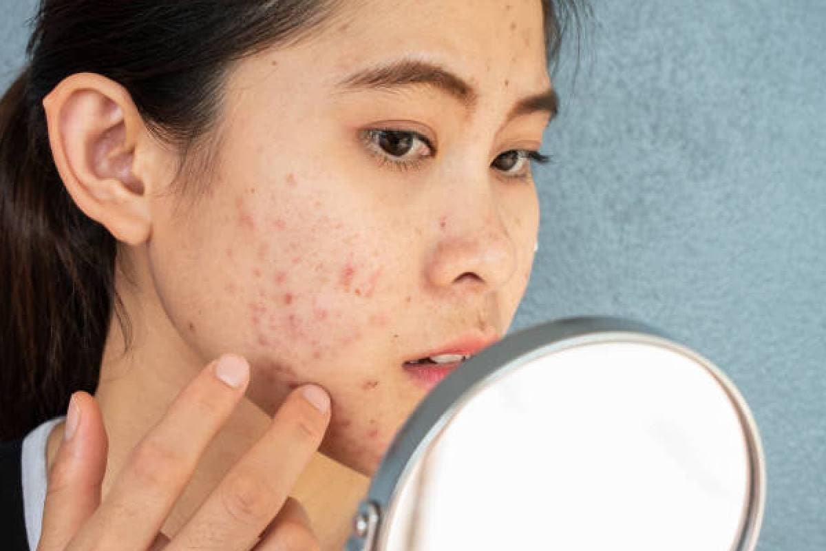 Skin Care Tips: क्यों होते हैं पिंपल्स, जानिए कैसे पाएं छुटकारा?