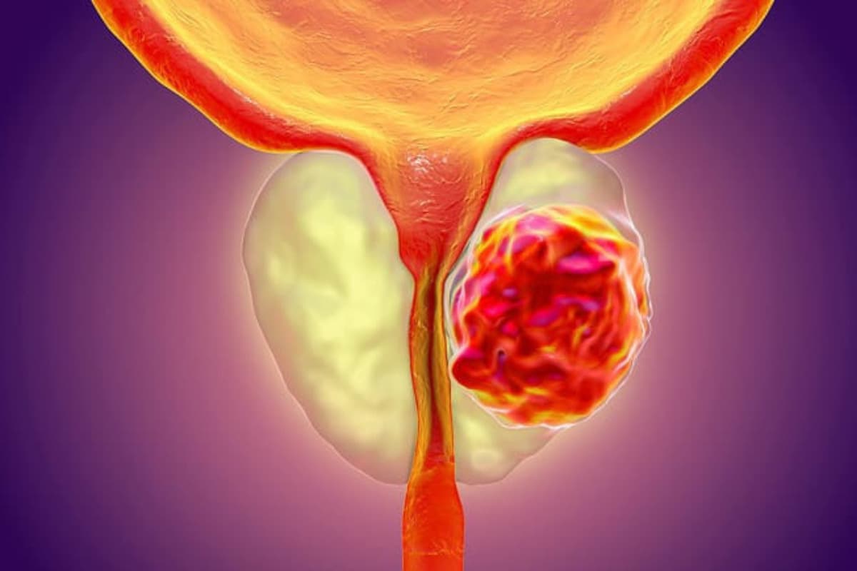 prostate cancer