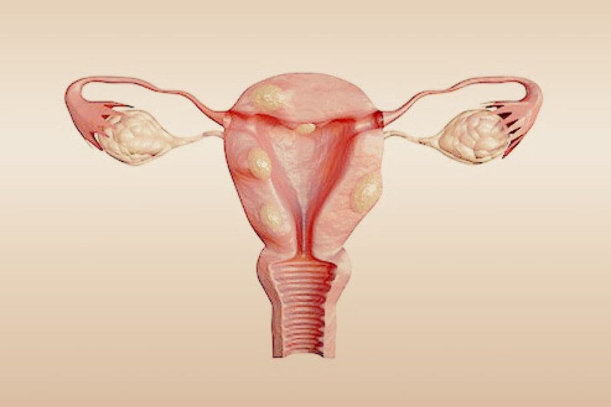 Uterine fibroids: गर्भाशय फाइब्रॉइड्स की वृद्धि को कैसे रोकें
