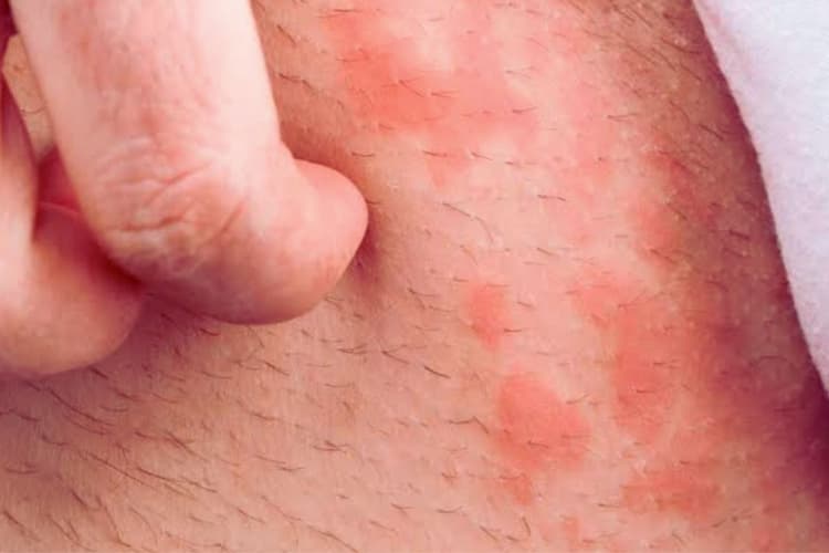 Groin fungal infection: ग्रोइन फंगल संक्रमण होता क्या है और इससे बचा कैसे जा सकता है?