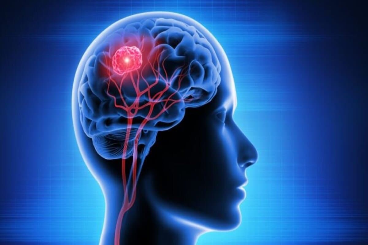 Brain Tumor: अगर आपको भी होती हैं यह  दिक्कतें, तो यह हो सकते हैं ब्रेन ट्यूमर के वार्निंग साइन