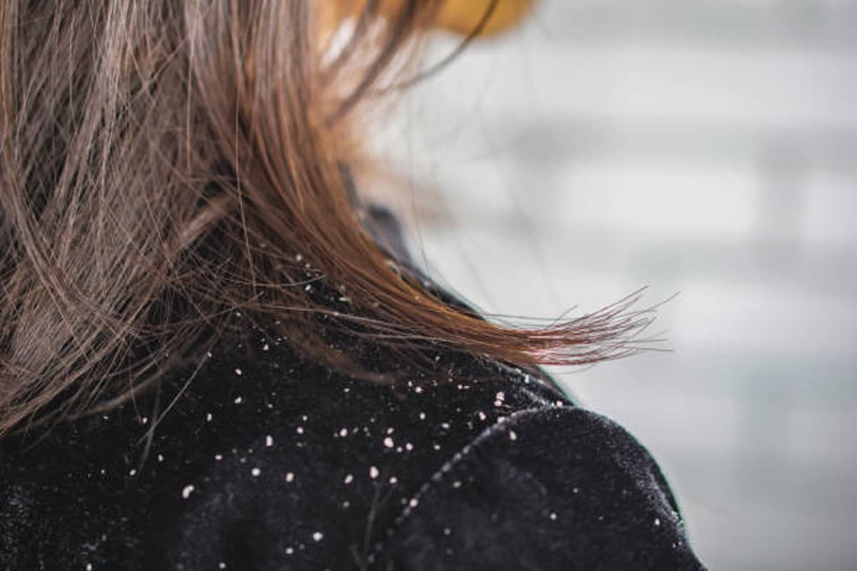 Beauty Tips : अब शैंपू की जरूरत नहीं,अपनाएं यह ट्रिक दो दिन में मिलेगा डैंड्रफ से छुटकारा