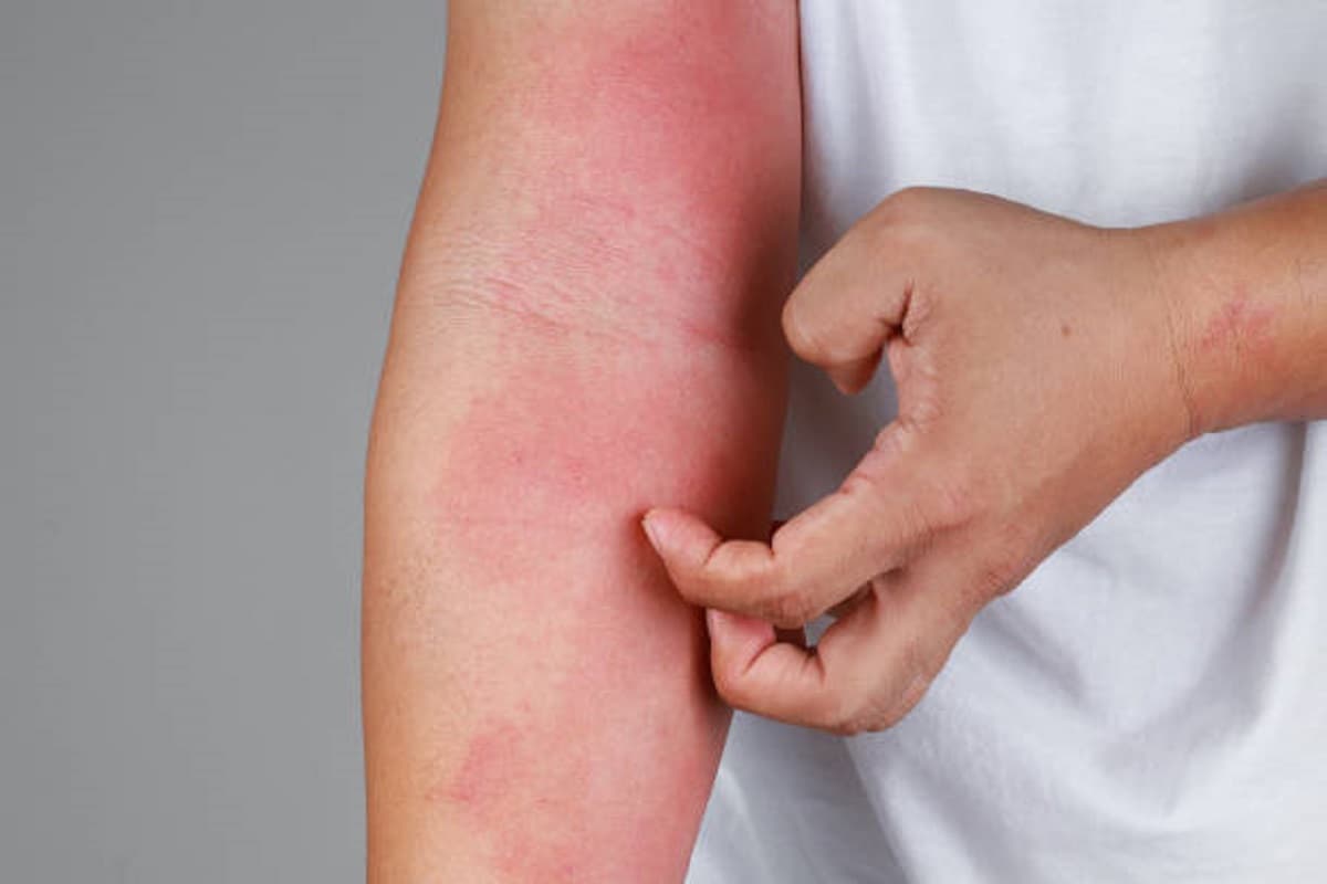 Skin Allergy: स्किन ऐलर्जी से तुरंत राहत पाने के लिए अपनाए ये घरेलू उपचार