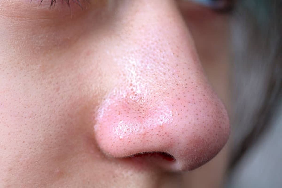 Skin Care Tips: ये हैं ब्लैकहेड्स हटाने के कुछ घरेलू उपाय