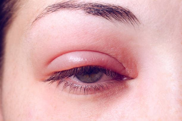 Barley infection on the eye.