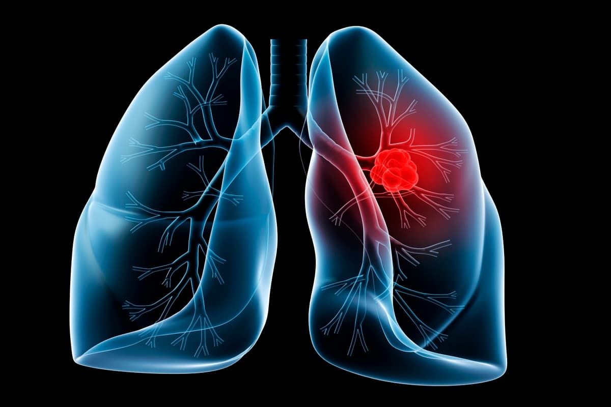 Lung Cancer : नॉन स्मोकर्स को ज़्यादा होता है लंग कैंसर का खतरा, क्या है इसके पीछे की वजह