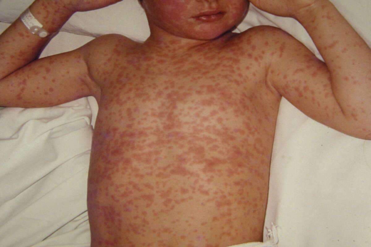 Measles Disease : क्या होते हैं खसरा के लक्षण, जाने कारण एवं बचाव के तरीके.
