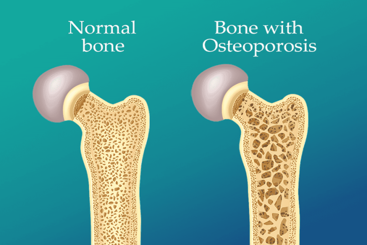 Low Bone Density : महिलाओं में क्यों होती है लो बोन डेंसिटी की समस्या?