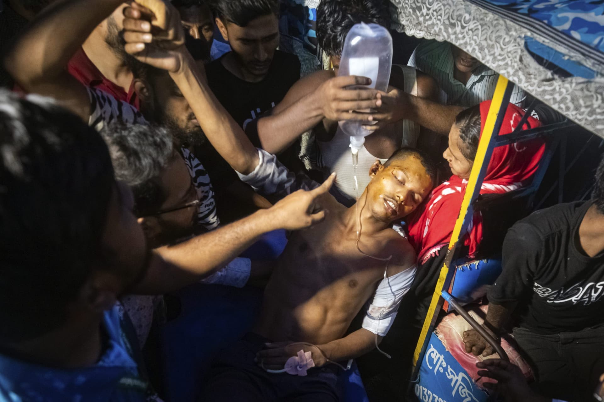 Bangladesh Crisis: बांग्लादेश में घायलों से भरे अस्पताल, भारतीय डॉक्टरों को 17 से 18 घंटे करना पड़ रहा काम