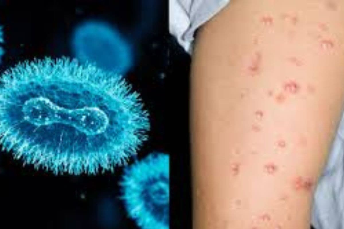 Monkeypox virus: कई देशों में फैला मंकीपॉक्स, जानें बचने के उपाय