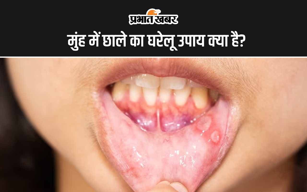 Mouth Tips: मुंह में छाले का घरेलू उपाय क्या है?