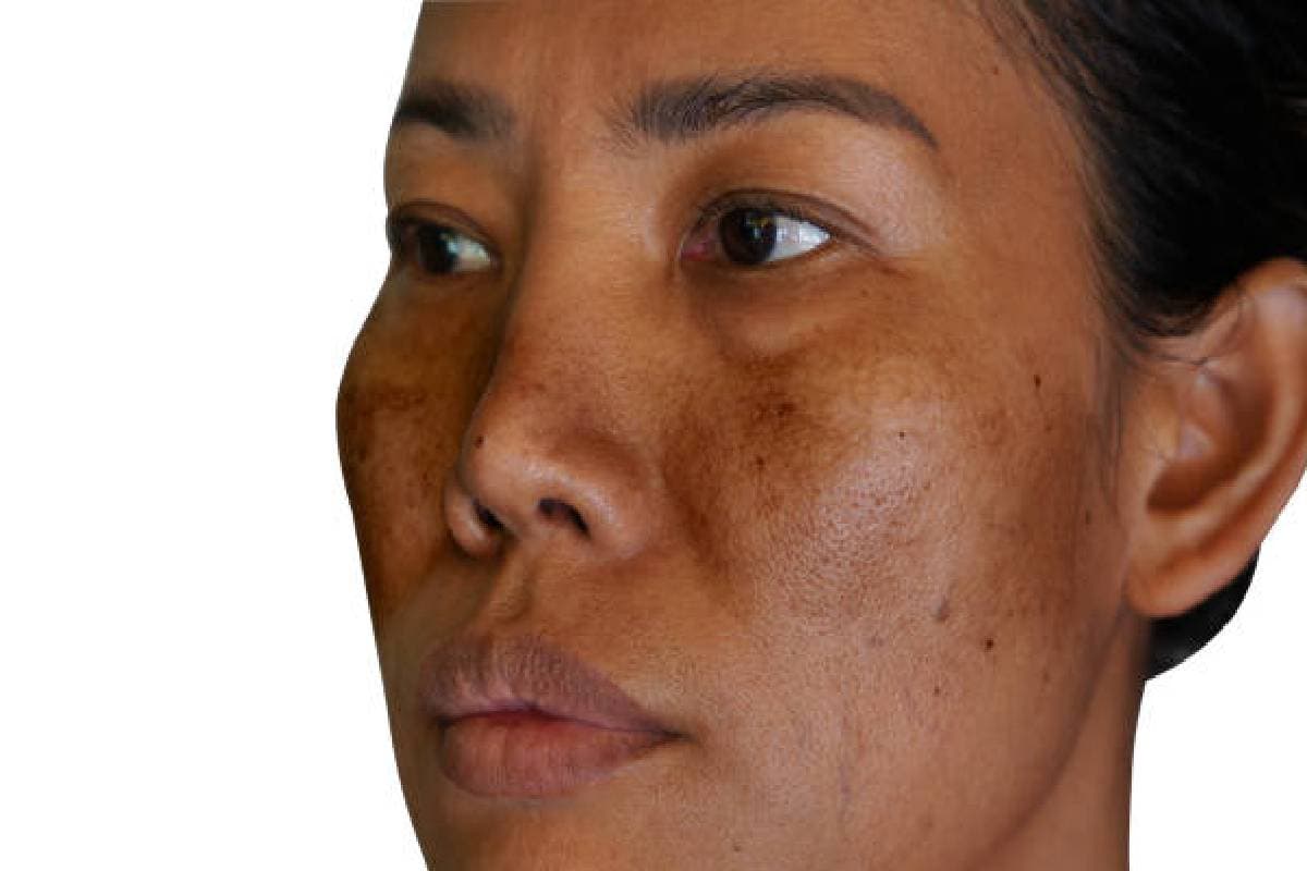 Reduce Pigmentation: इन 5 तरीके से हटाएं पुराने से पुराना पिगमेंटेशन, जानें कैसे