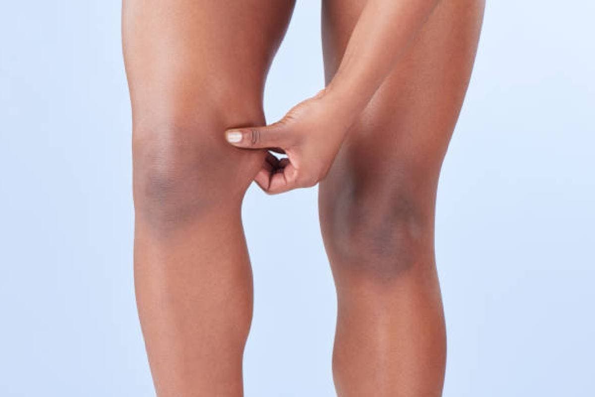 Skin Brightening Tips: काली कोहनी और घुटनों को कैसे चमकाएं, बस नारियल तेल में ये मिलाएं, जानें लगाने की विधि