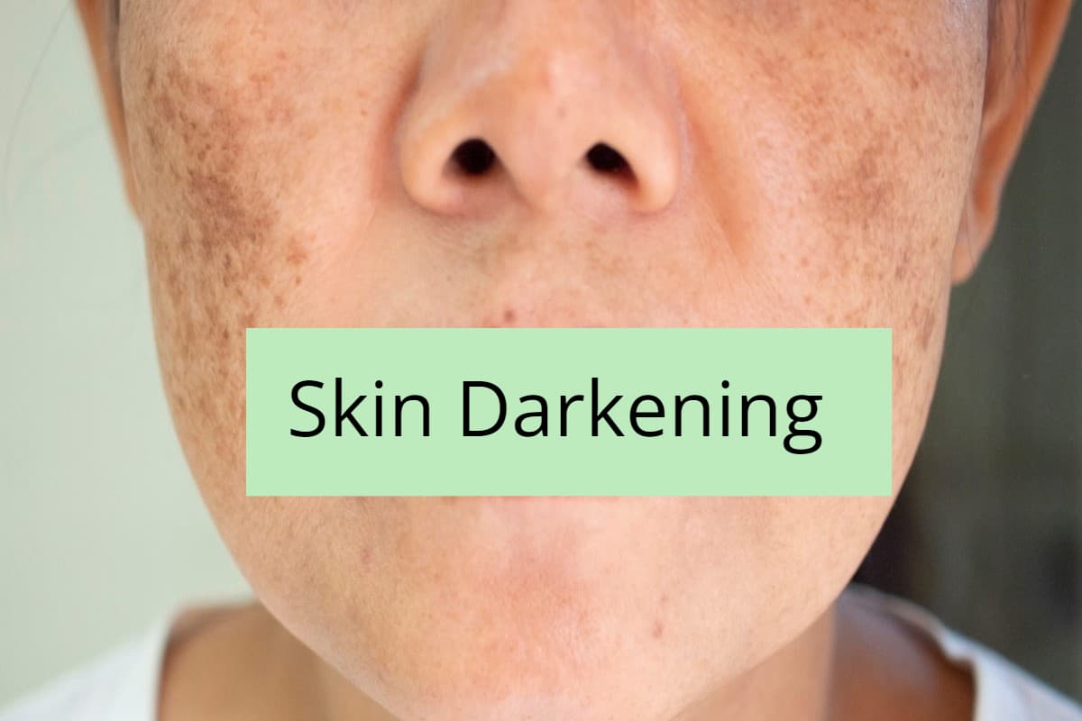 Skin Darkening: इस विटामिन की कमी से चेहरा पड़ जाता है काला