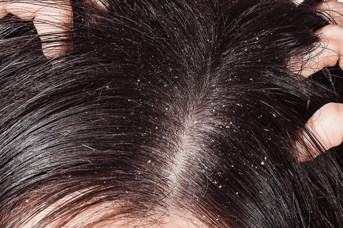 Hair care: बरसात में बालों को झरने और डैंड्रफ से छुटकारा दिलाने के बेस्ट घरेलू नुस्खे