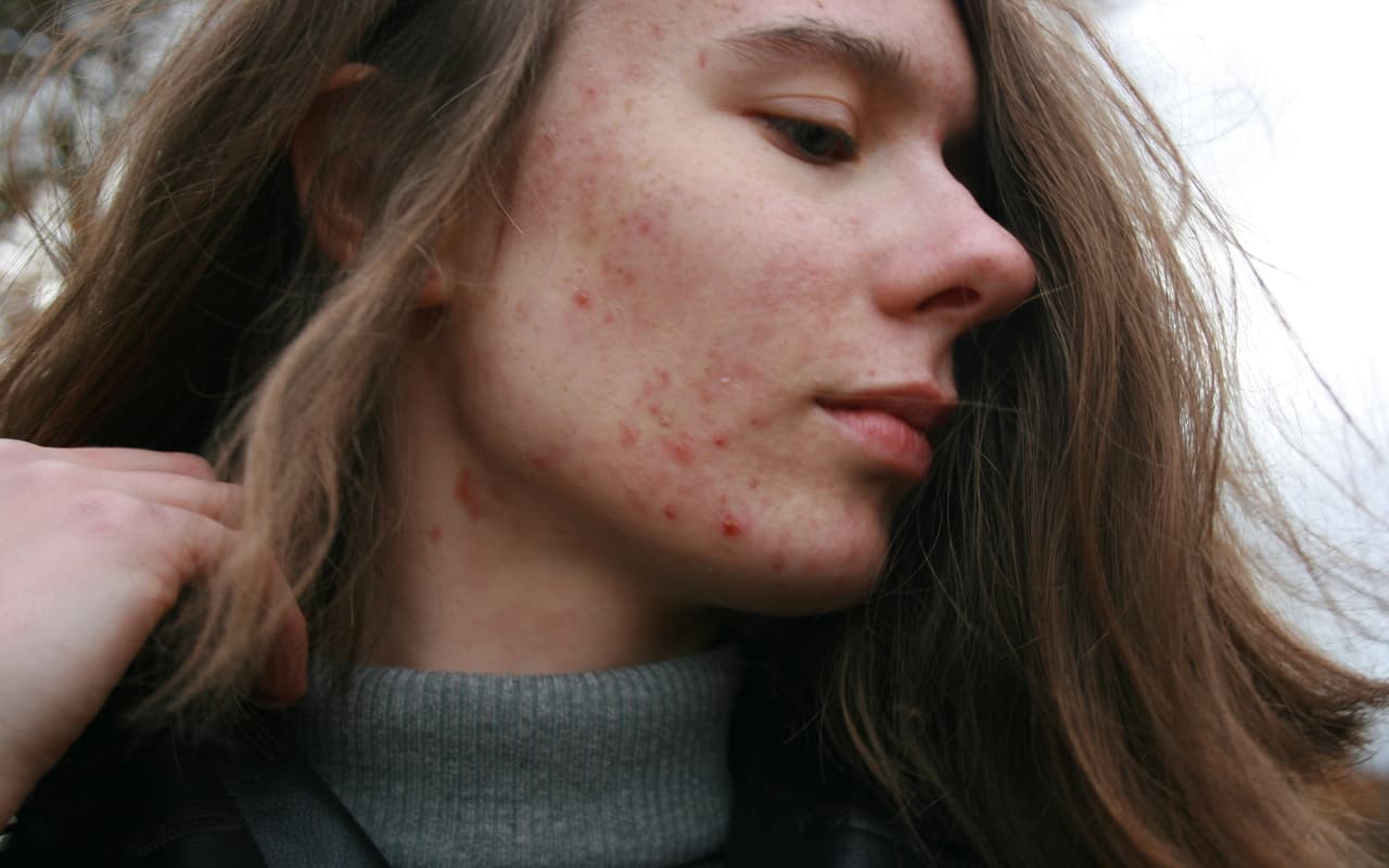 Beauty Tips: बारिश के मौसम में भी न आने दें चेहरे पर एक्ने, जानें क्या है तरीका
