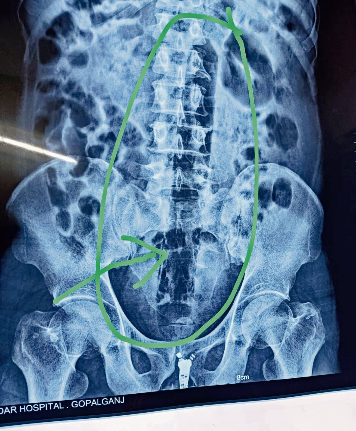 चनावे जेल में बंद विचाराधीन कैदी ने गुप्तांग में डाला एक फुट लंबा पाइप, हालत बिगड़ी, पीएमसीएच रेफर