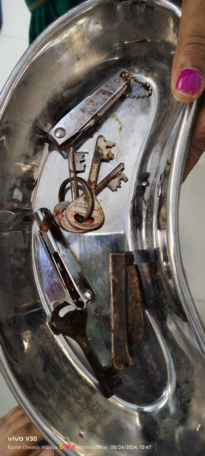 बिहार के मोतिहारी में युवक के पेट से निकला चाभी का गुच्छा, चाकू व नेलकटर