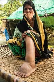 Eliminate Lymphatic Filariasis: रोग के निपटारे के लिए 63 जिलों में शुरू किया गया अभियान