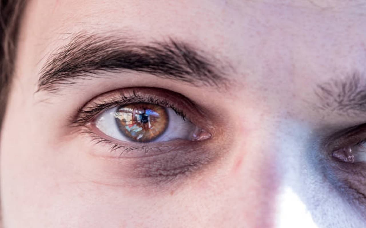 Remedies for Dark Circle: आंखों के नीचे से डार्क सर्कल हटाने के लिए अपनाएं ये घरेलू उपाय