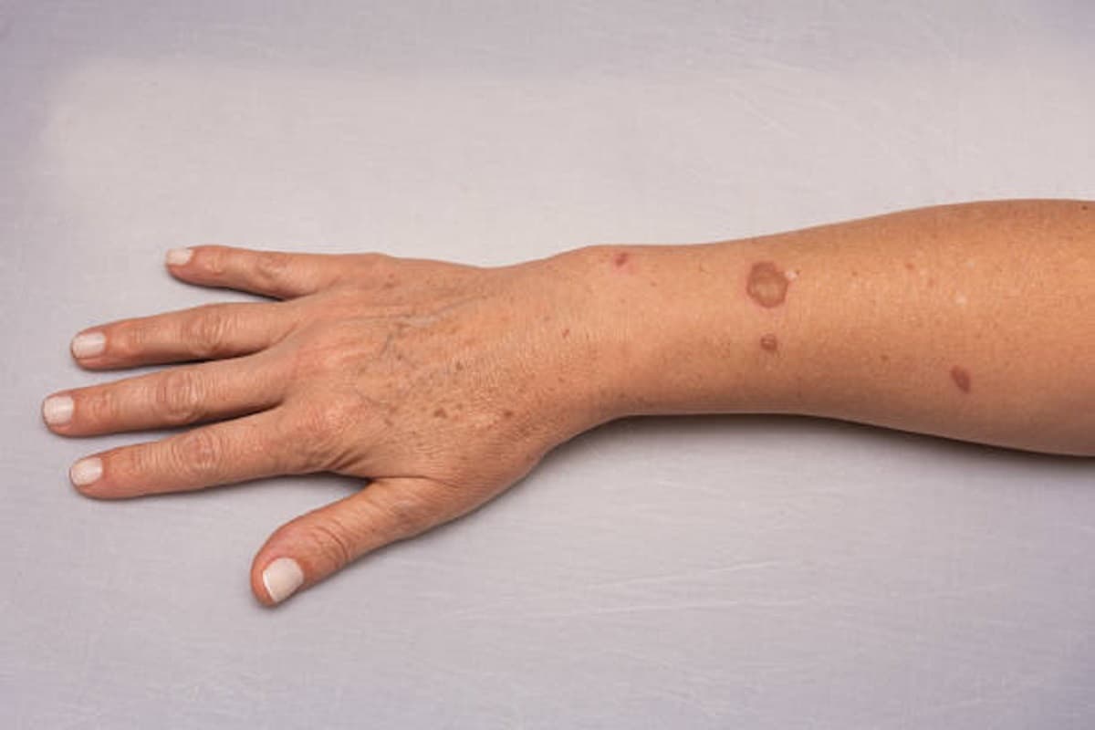 Skin care: त्वचा पर गर्म तेल की छींटे पड़ने पर क्या करें?