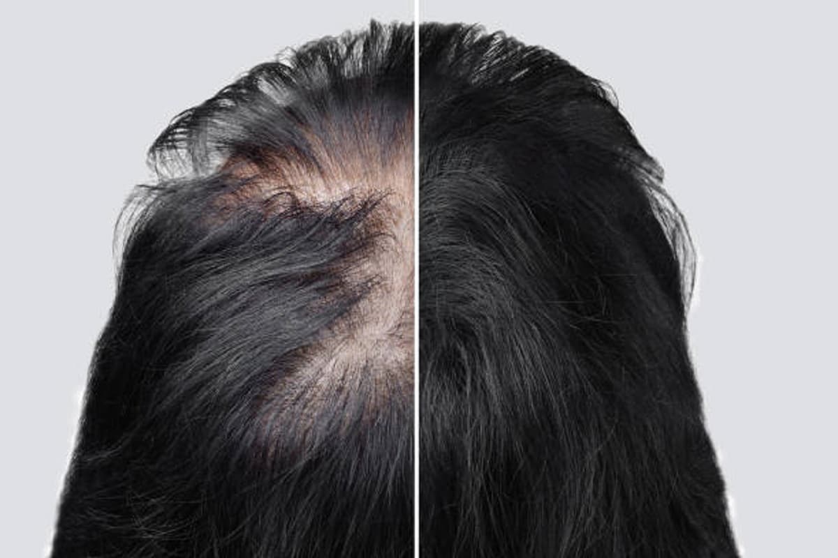 Hair Care Tips: बालों को घना करने के घरेलू उपाय
