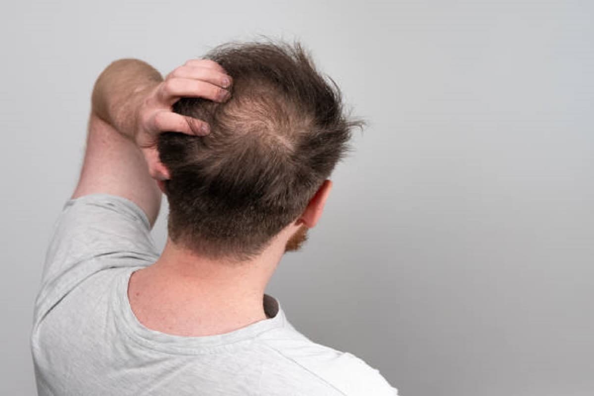 Monsoon Hair Care for Men: अपने बालों को झड़ने से रोकने के लिए फॉलो करें ये टिप्स