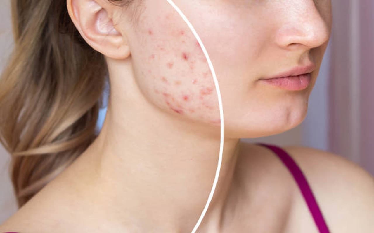 Skin Care Tips: पिंपल्स से छुटकारा पाने में मदद करेंगे, आसानी से बनने वाले ये फेस पैक